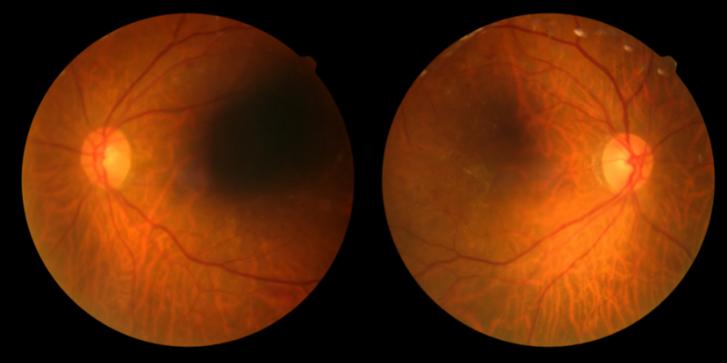 optica-crealens-retinopatía-diabética